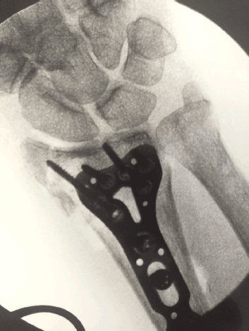 x-ray image of broken wrist with screws and plates